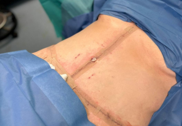 Abdominoplastik nach Bauch-Liposuktion: Lyns Erfahrungsbericht