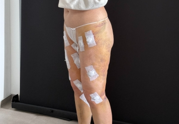 Wie die Heilung nach einer Liposuktion bei Lipödem verläuft