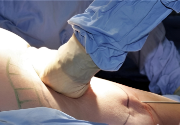 G-BA-Beschluss 2025: Die Liposuktion bei Lipödem wird Kassenleistung in allen Stadien.