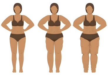 Lipödem Stadien erklärt: Was Stadium 1, 2 und 3 bedeuten und was nicht.