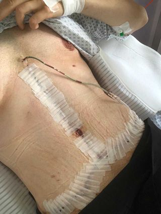 Bauchdeckenstraffung beim Mann, Abdominoplastik beim Mann, OP Eingriff mit T-Schnitt
