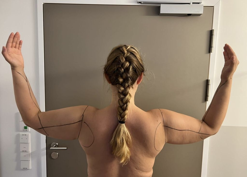 Lipödem Heldin Juliane vor ihrer Arm-Liposuktion. An den Armen sind die Bereiche angezeichnet, die behandelt werden.
