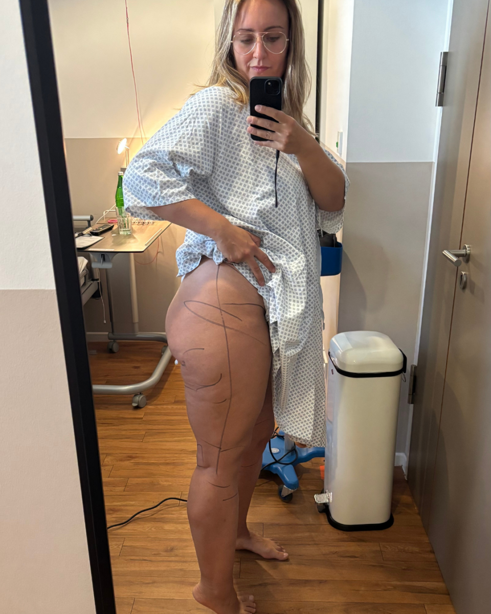 Lipödem Heldin Juliane steht im OP-Kittel vorm Spiegel. An ihren Beinen sind die Areale angezeichnet, die operiert werden.