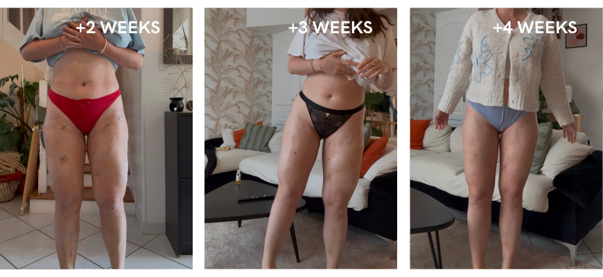 Sylvies Ergebnis nach ihrer Liposuktion, 2 bis 4 Wochen nach der OP 