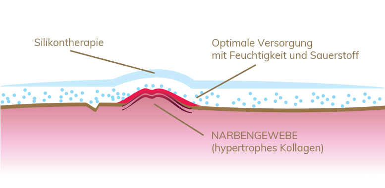 Wirkung von Narbenpflege aus Silikon auf das Narbengewebe. Abbildung der Hautschichten.